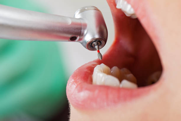 Best Emergency Tooth Extraction in Rafter J Ranch, WY